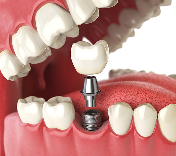 Allendale Charter Twp Will I Need a Bone Graft for Dental Implants