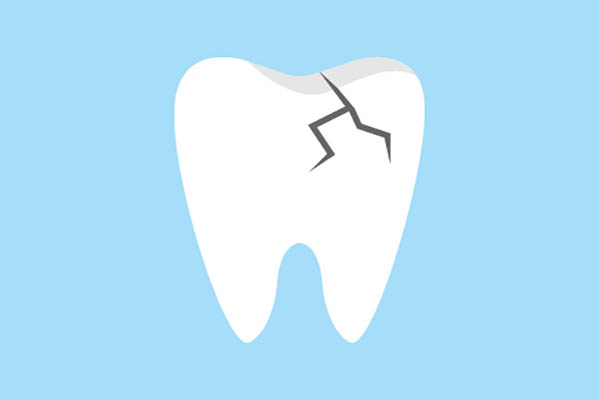 A Dentist&#    ;s Recommendation On How To Treat A Broken Tooth