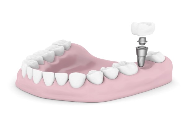 Comparing Dental Implants Vs  Dental Bridges