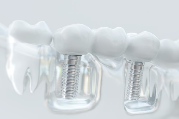 Dental Implants Allendale Charter Twp, MI