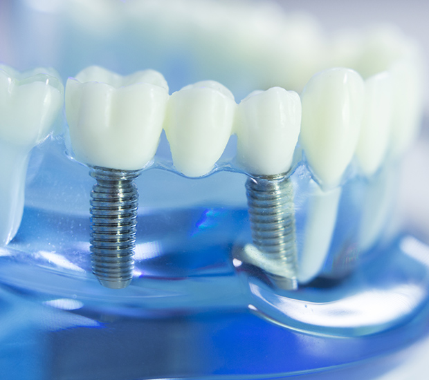 Allendale Charter Twp Dental Implants