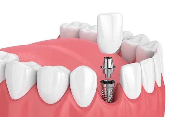 How Painful is Dental Implant Surgery from Grand Valley Dentistry in Allendale Charter Twp, MI