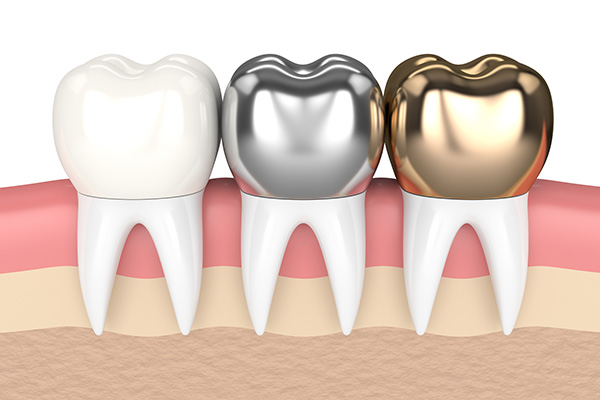 Metal Crowns vs. Porcelain Dental Crowns from Grand Valley Dentistry in Allendale Charter Twp, MI