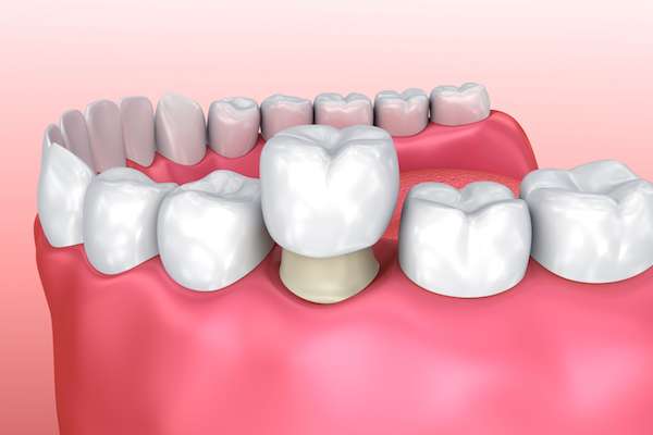 Permanent Dental Crowns vs. Temporary: Is There a Difference from Grand Valley Dentistry in Allendale Charter Twp, MI
