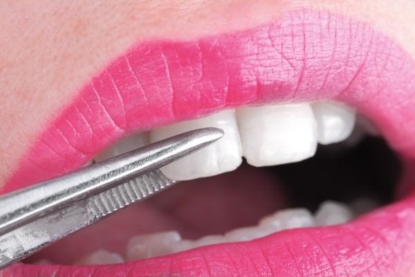 Explore Your Options With Dental Veneers From A Dentist